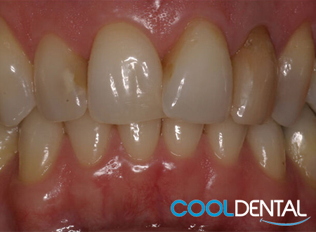 Before Photo of Bruxism in the top row of Teeth.
