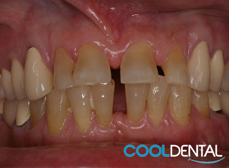 Before Photo of Gaps In Teeth and Plaque Build Up.