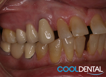 Before Photo of Misaligned Teeth and Gaps.
