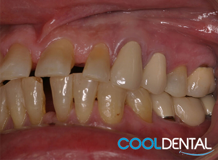 Before Photo of Misaligned Teeth and Uneven Gaps.