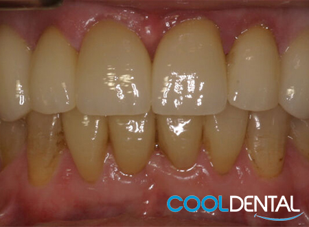After Photo of Gaps In Teeth and Plaque Build Up Removed and Treated at Cool Dental.