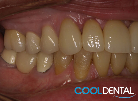 After Photo of Misaligned Teeth and Gaps Fixed With Reshaping, Crowns And Implants. 