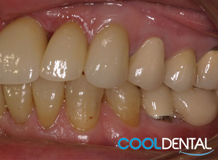 After Photo of Misaligned Teeth and Uneven Gaps fixed with Crowns And Veneers.