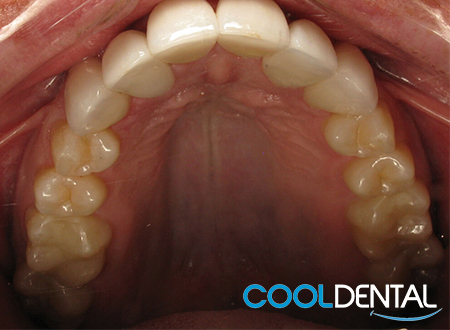 After Picture of Teeth Alignment using crowns and Sedation.