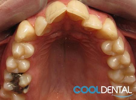 Before Picture of Teeth Alignment using crowns and Sedation.