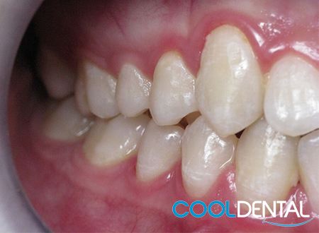 After Photo of Teeth Fixed With Braces by Cool Dental.