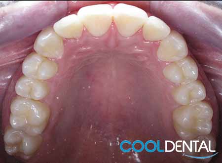 After Photo of Teeth Fixed With Braces by Cool Dental.