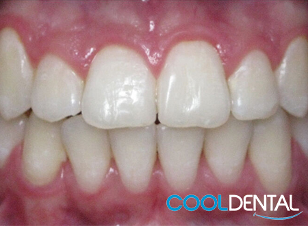 After Photo of Teeth Fixed With Braces by Cool Dental.