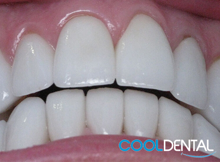 After Photo of Front Teeth Completed.