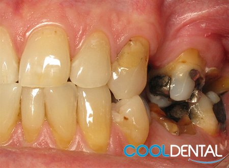 Before Photo of stained Teeth and Worn Out Metal Fillings.