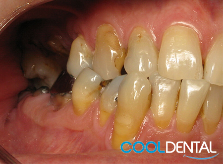 Before Photo of Heavily Damaged Teeth and Gum Loss.