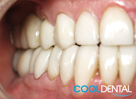 After Photo of Teeth Fixed With Sedation Therapy, Dental Bridge Installed and Crowns to Reinforce existing Teeth.