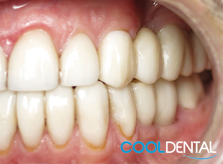 After Photo of stained Teeth and Worn Out Metal Fillings Replaced with Ceramic Crowns And Cleaned.