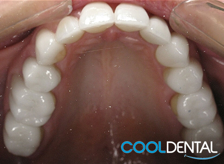 After Photo of Misaligned Teeth and Metal Fillings Fixed with Ceramic Veneers