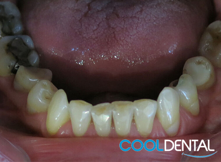 Before Photo Showing Teeth in Need of Cleaning, Reshaping and Fillings Replacement.