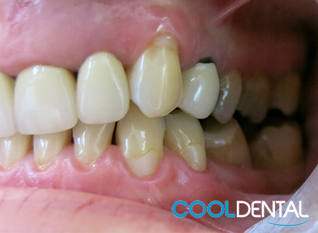 Patients Teeth Before Dental Cleaning and Fillings 