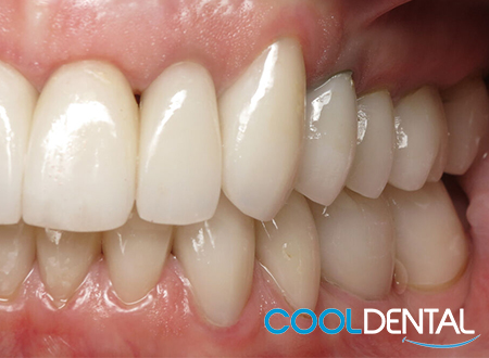 After Photo of Dental Cleaning and Filling