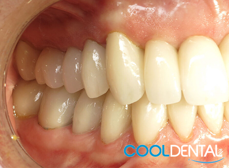 Patients Teeth After TMJ Treatment and Filling Replacement.