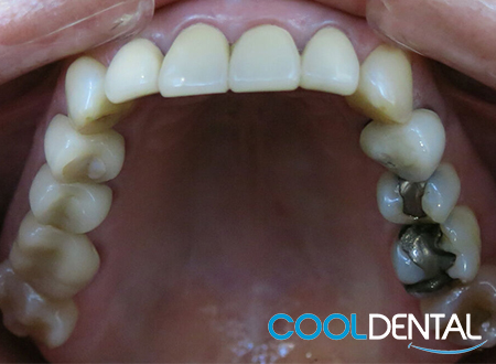 Photo of Patients Teeth Before a Fillings Replacement.