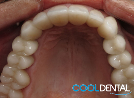 Photo of Patients Teeth After a Fillings Replacement.