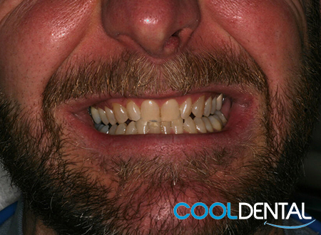 Lower Jaw Photo of Smile Before Treatment at Cool Dental.