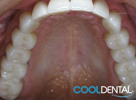 Photo of teeth After Dental Cleaning, Filling removal and Crowns.