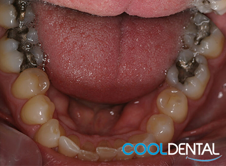 Another Photo of teeth before Dental Cleaning, Filling removal and Crowns.