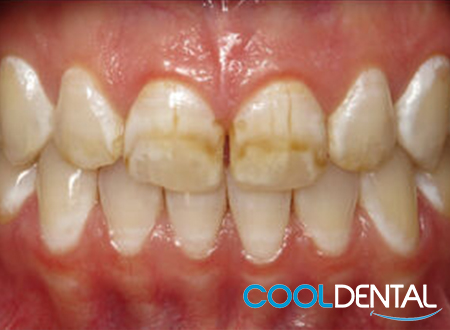 before photo of stained teeth.