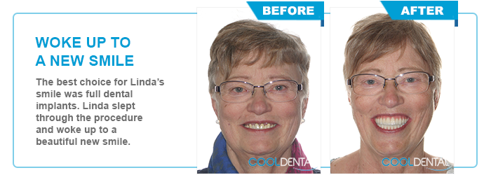 Linda's Before and After Full Dental Implant Comparison