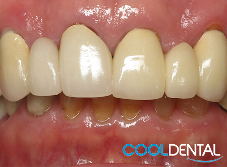 Picture of Linda's Teeth Before Dental Implants.