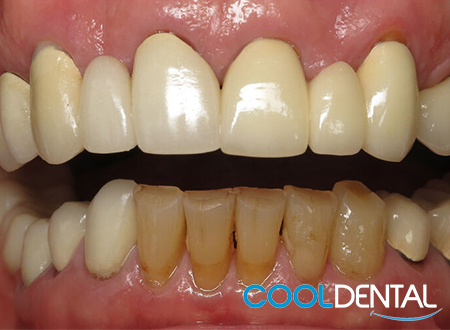 Second Picture of Linda's Teeth Before Dental Implants.