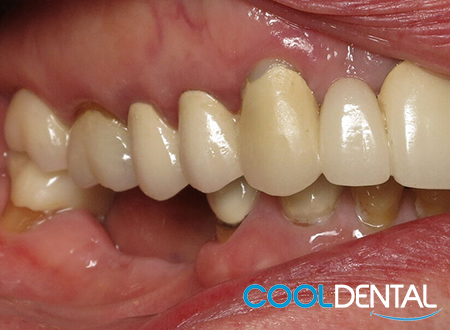 Third Picture of Linda's Teeth Before Dental Implants.