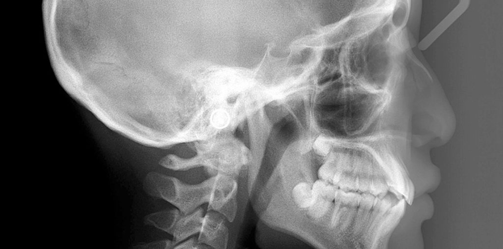 Cephalometric X-ray