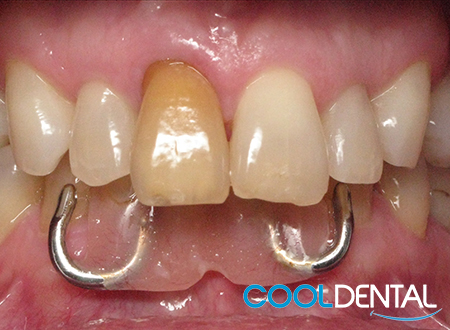 Before Photo of a Smile Missing Teeth and Showing Discoloration.