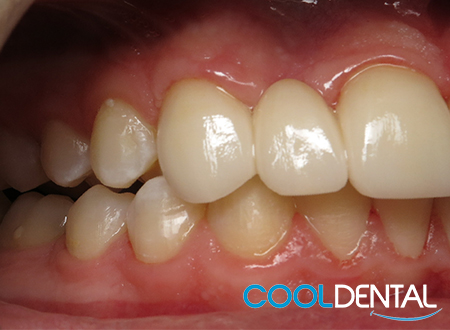 second set of teeth with Veneers