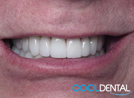 After Photo of Ceramic Crowns