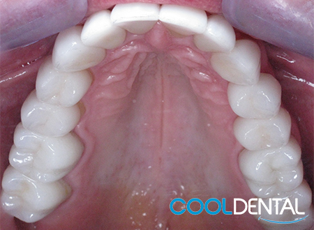 After Photo of Ceramic Crowns