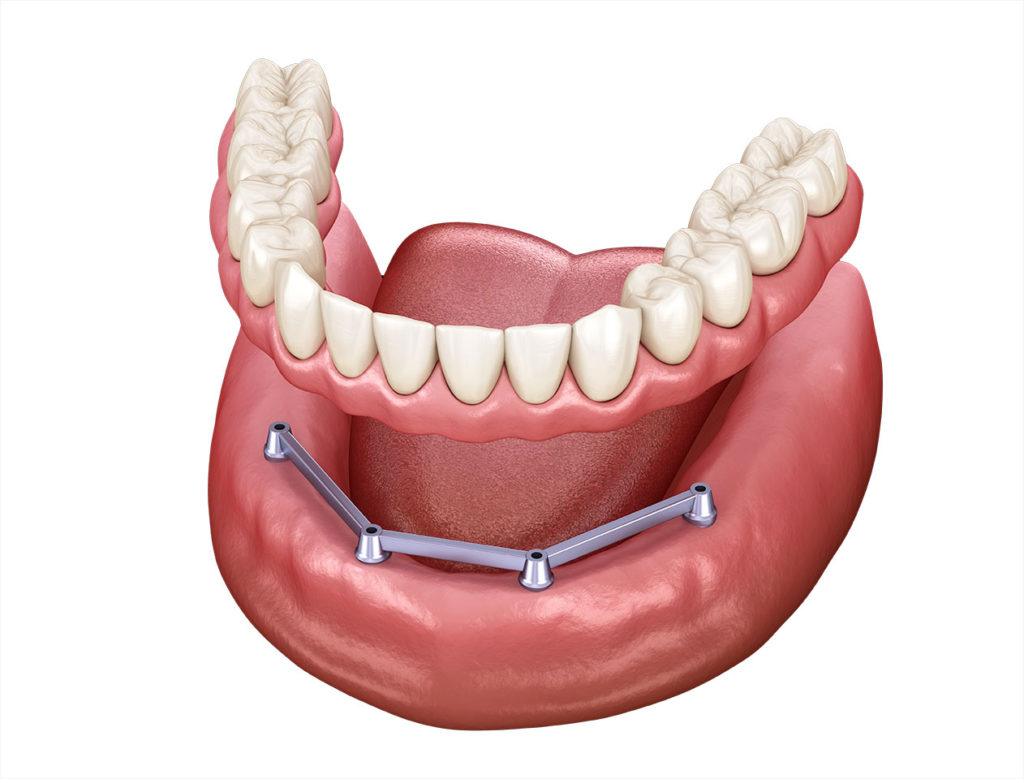 Bar-retained dentures