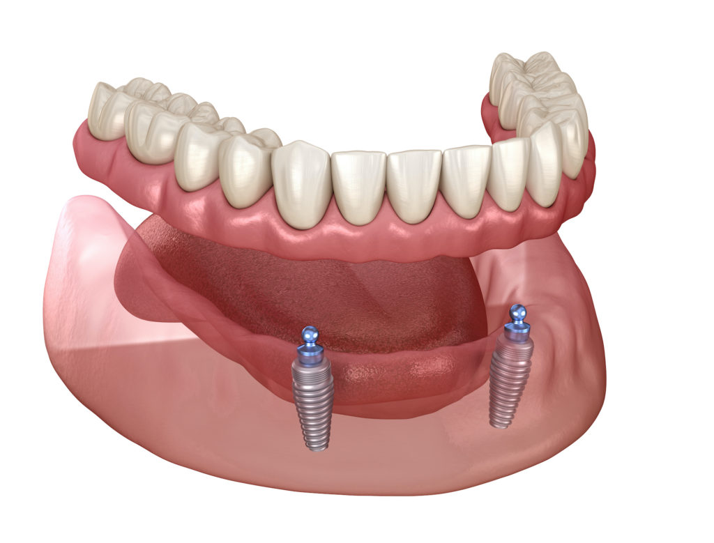 Ball-attached dentures